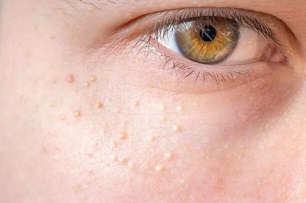 What exactly are those white bumps on your face?